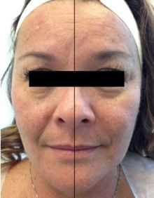 ハイドロフェイシャル