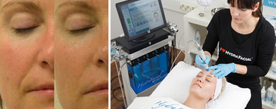 最新美容！ハイドラフェイシャル $50引き 