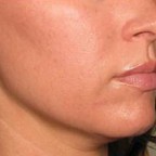 切らないリフト＆刺青除去がお得！ 12月のキャンペーン