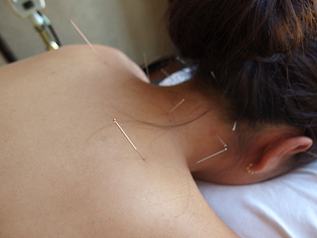 ハワイのジュジュベホリスティッククリニックで鍼治療