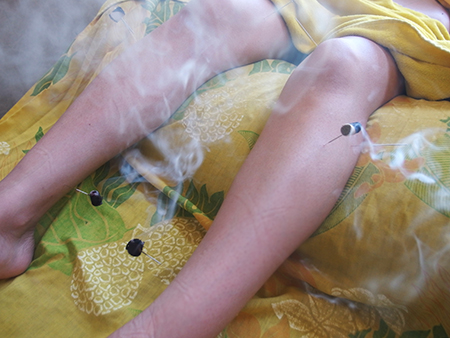 ハワイのジュジュベホリスティッククリニックで鍼治療