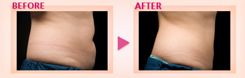 部分痩せ脂肪凍結 マシンゼルティック