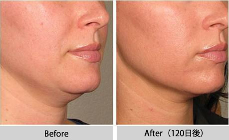 最新ウルセラピー