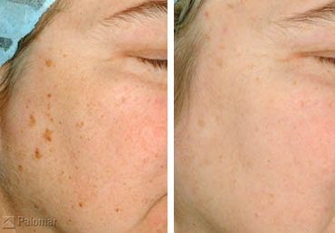 ハイドロフェイシャル