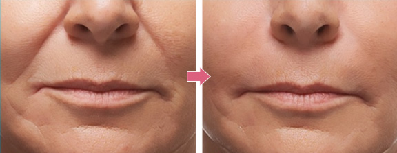 ヒアルロン酸 ベロテロ