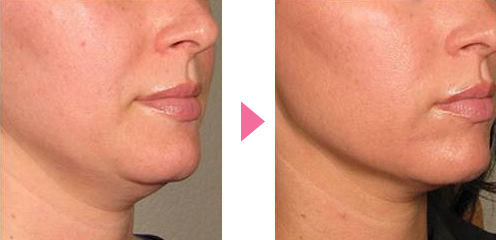 たるみ引き上げ ウルセラピー