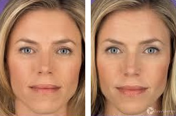 ヒアルロン酸ジュビダーム