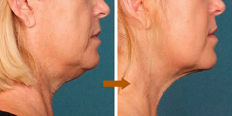 注射で二重アゴ解消 カイベラ