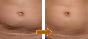 部分痩せマシン ゼルティック」