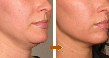 タルミ引き上げ治療 ウルセラピー