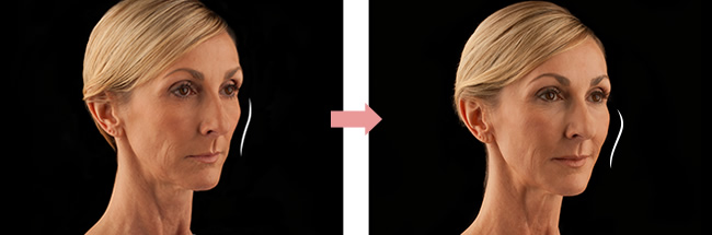 ハワイ美容整形 ヒアルロン酸ボリューマ