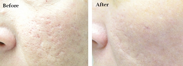 フラクショナルレーザー