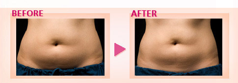 ハワイ美容整形 ヒアルロン酸ボリューマ